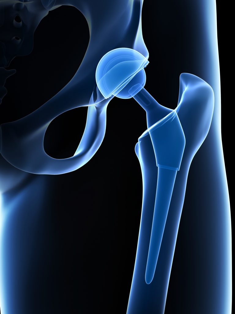 3D illustration of total hip replacement - Orlando Orthopaedic Center