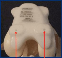 Figure 2a. Frontal view of Custom ShapeMatch guide applied to the femur. Partial (uni-compartmental) cutting guides are also available.