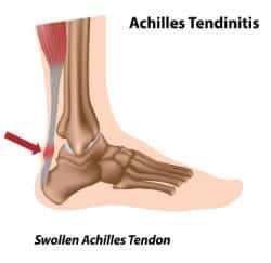 Achilles tendinitis