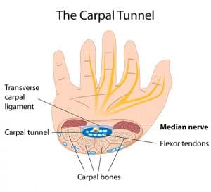 Carpal tunnel steroid injection video