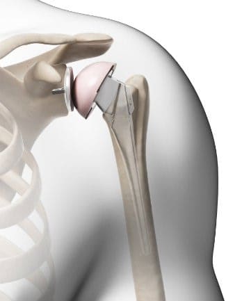 A computer rendering of a total shoulder replacement.