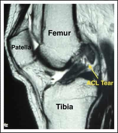 MRI Image of a Torn ACL - Orlando Orthopaedic Center