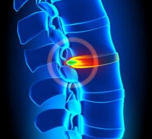 Herniated Disc Treatment at Orlando Orthopaedic Center