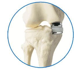 Benefits-of-Outpatient-Partial-Knee-Replacement