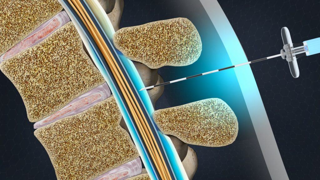 Epidural Steroid Injection Epidural Steroid Injection