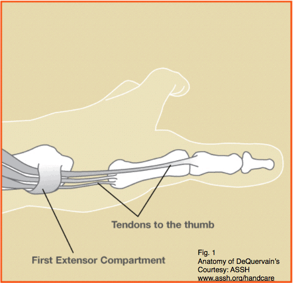 DeQuervain’s Tenosynovitis fig 1