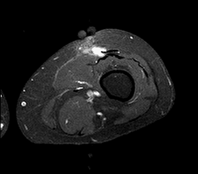 orthopaedic-oncology-MRI-scan