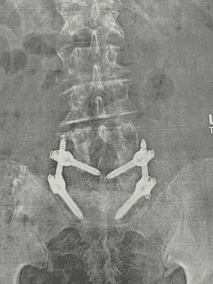 Recovery-Like-Following-Interbody-Fusion-Surgery