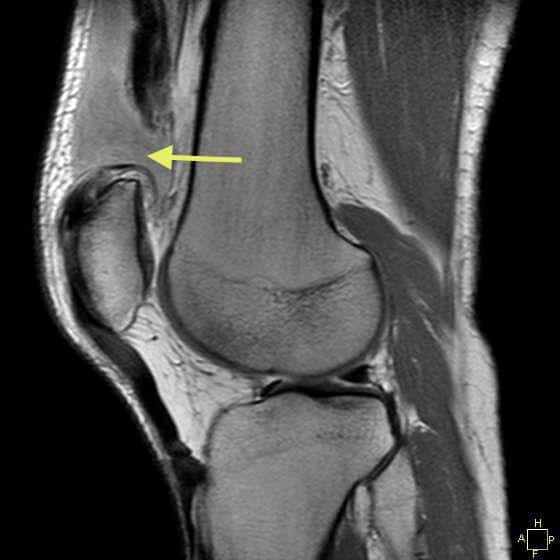 Rick Right Knee Ruptured Quadriceps Tendon