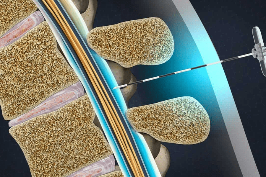 An illustrative image of a lumbar injection, which shows a needle injected between two vertebrae