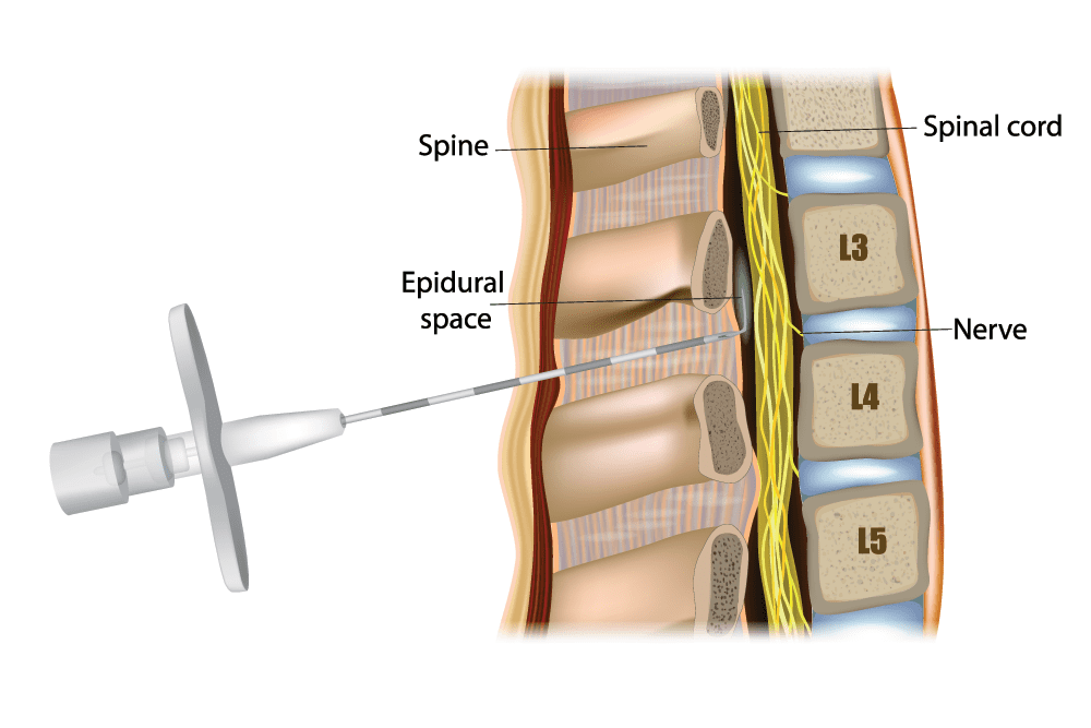 A textbook illustration of a lumbar injection through the epidural space into the spinal cord 