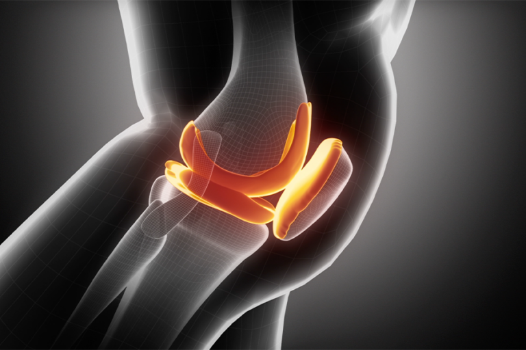 Why Lateral Approach Total Knee Replacement Might Be a Better Choice